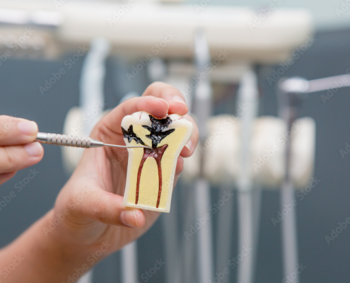 Explication Modele Dent Endodontie D1