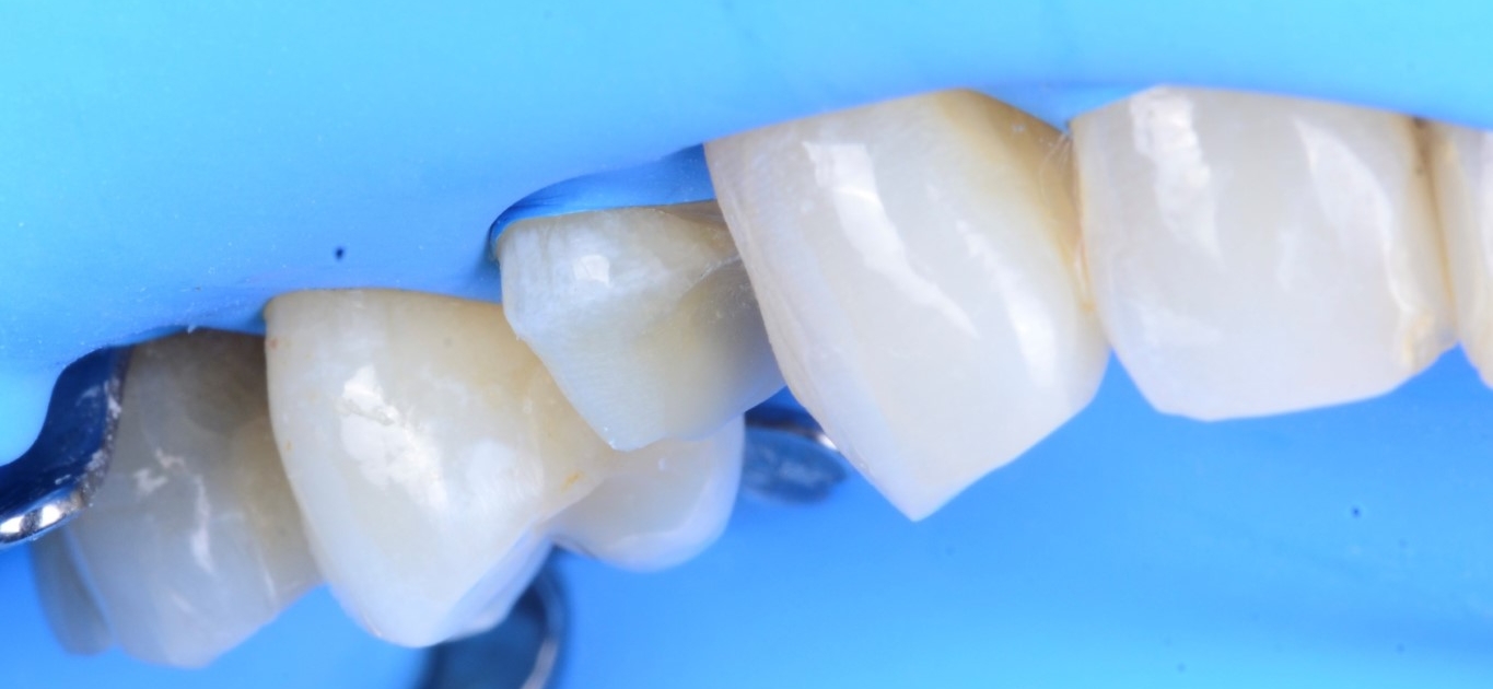 Un patient corrige une cassée