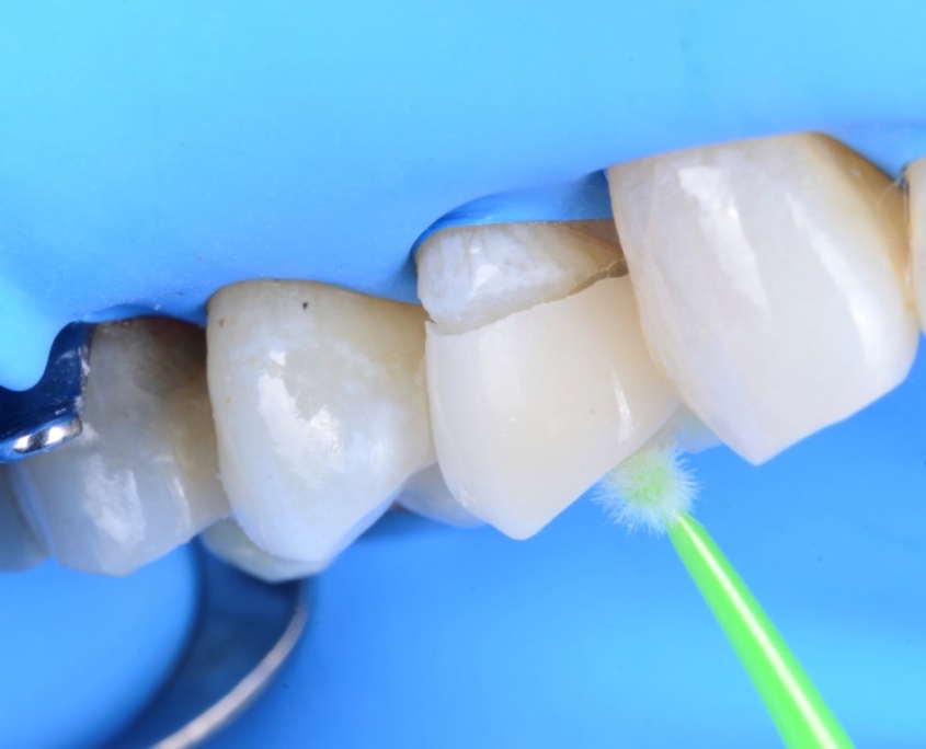 Dentisterie D1 Dental Concept 02 Réparation de la dent cassée