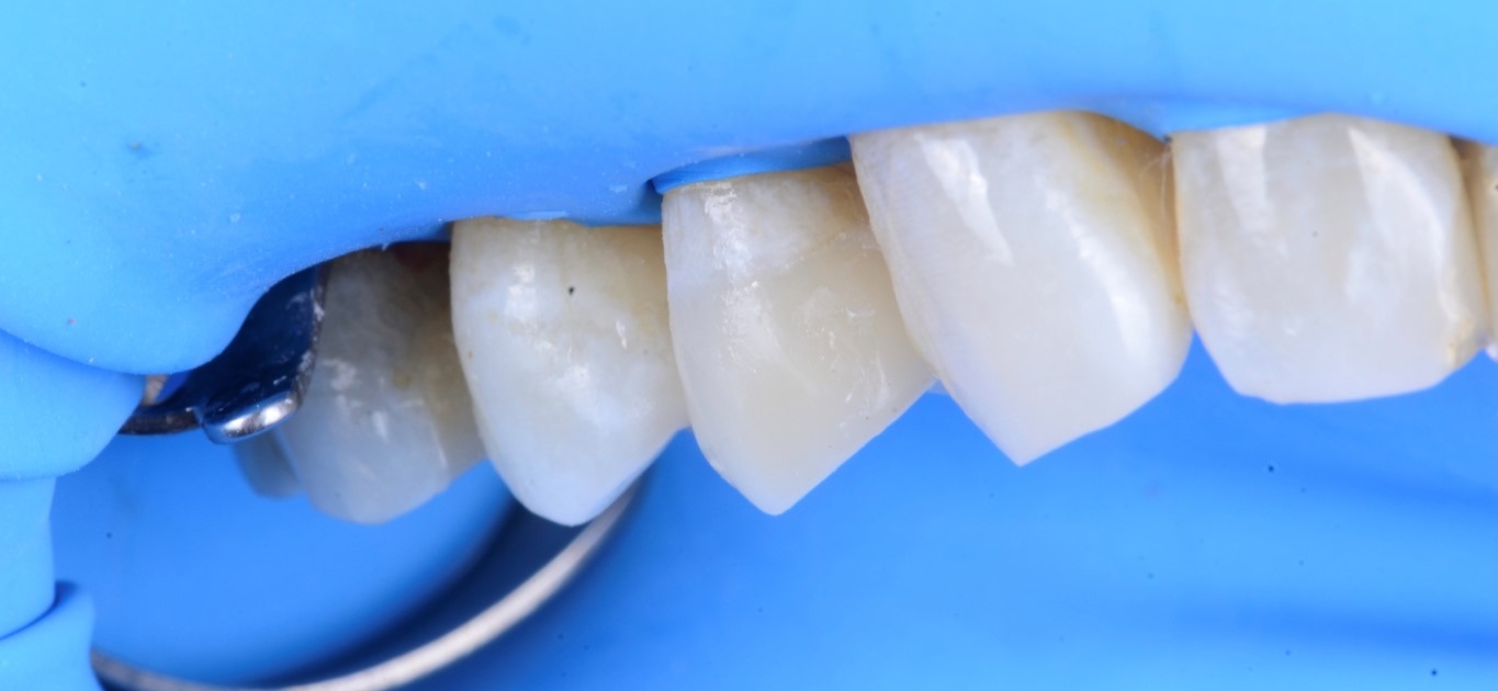 Résultat de la dent réparée