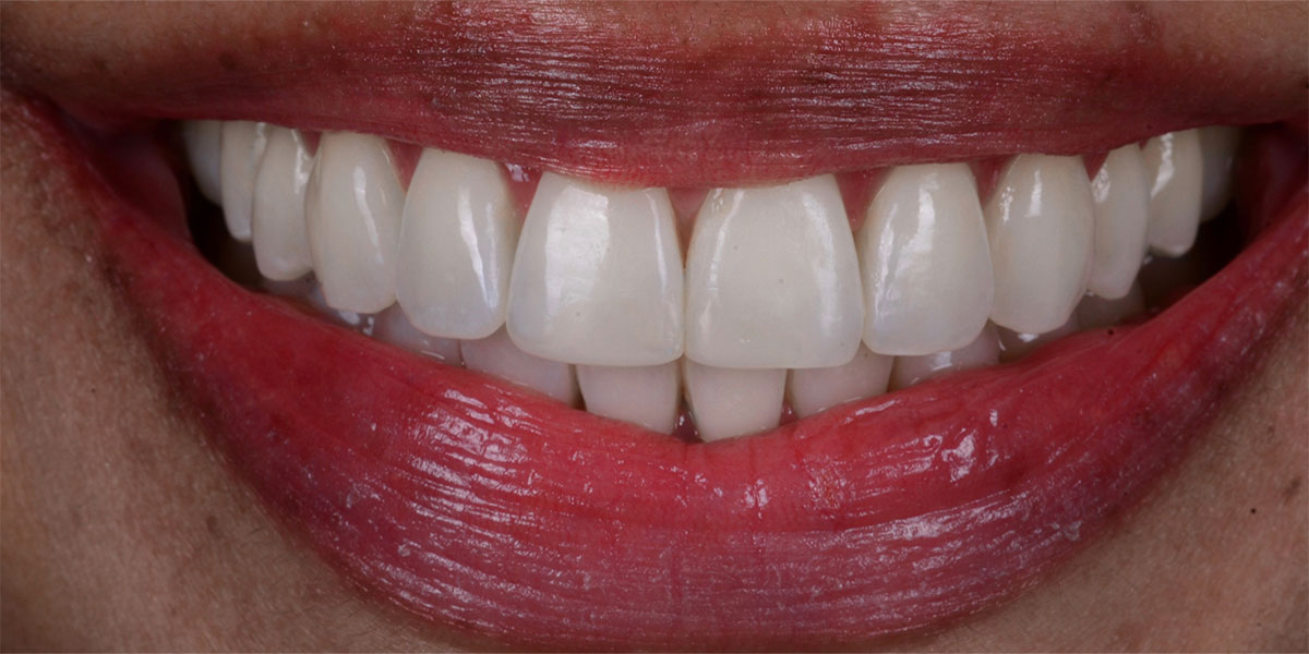 Blanchiment Dentaire Au Fauteuil Chez D1 Dental Concept Mont-sur-Lausanne