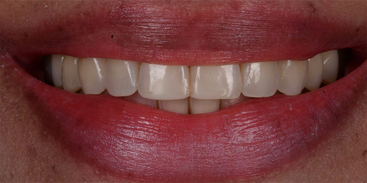 Blanchiment Dentaire Au Fauteil Chez D1 Dental Concept Mont-sur-Lausanne