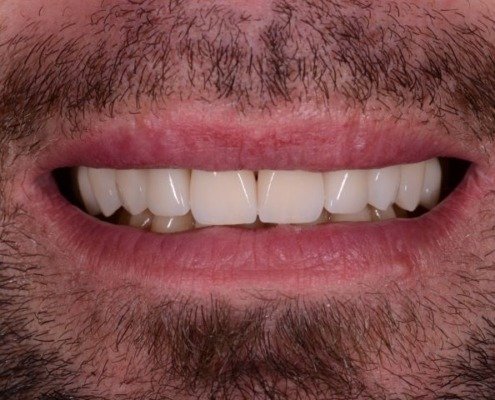 erosion dentaire Mont-sur-Lausanne