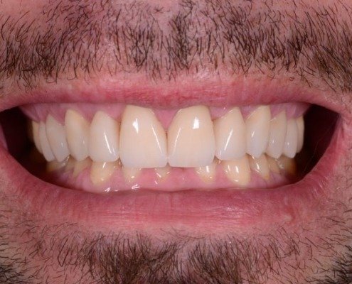 erosion dentaire Mont-sur-Lausanne