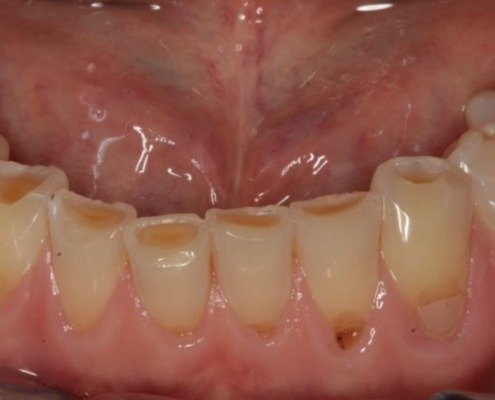 erosion dentaire Mont-sur-Lausanne