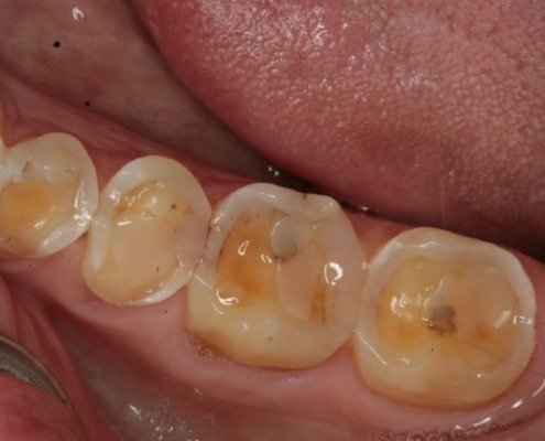 erosion dentaire Mont-sur-Lausanne