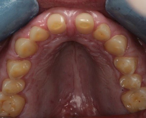 erosion dentaire Mont-sur-Lausanne