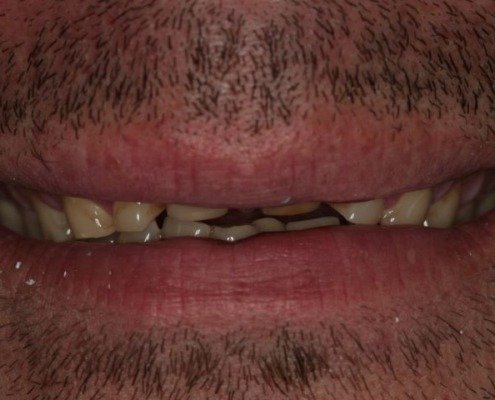 erosion dentaire Mont-sur-Lausanne