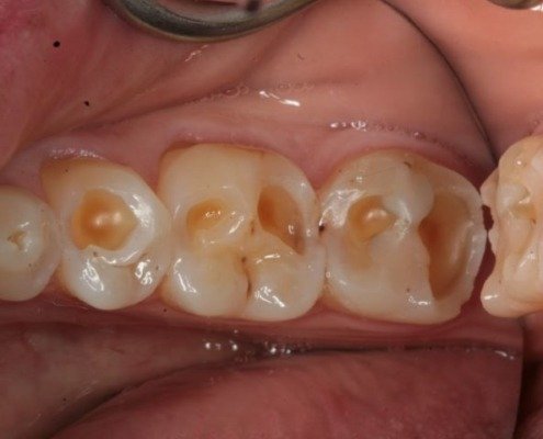 erosion dentaire Mont-sur-Lausanne