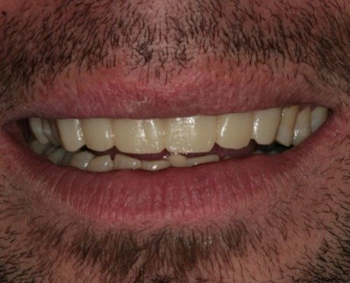 erosion dentaire Mont-sur-Lausanne