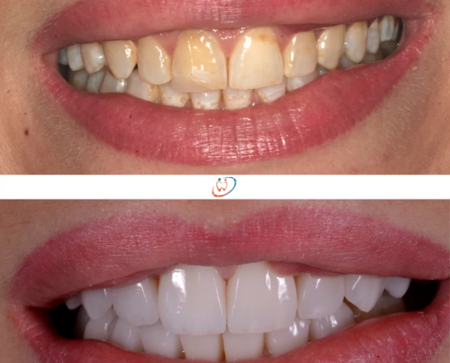 pose facette dentaire Mont-sur-Lausanne