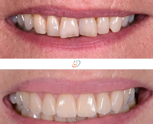 pose facette dentaire Mont-sur-Lausanne Avant/après la pose de facettes à des fins d'alignement des dents