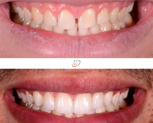 Avant/après la pose de facettes pour corriger un espace