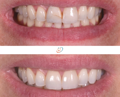 pose facette dentaire Mont-sur-Lausanne