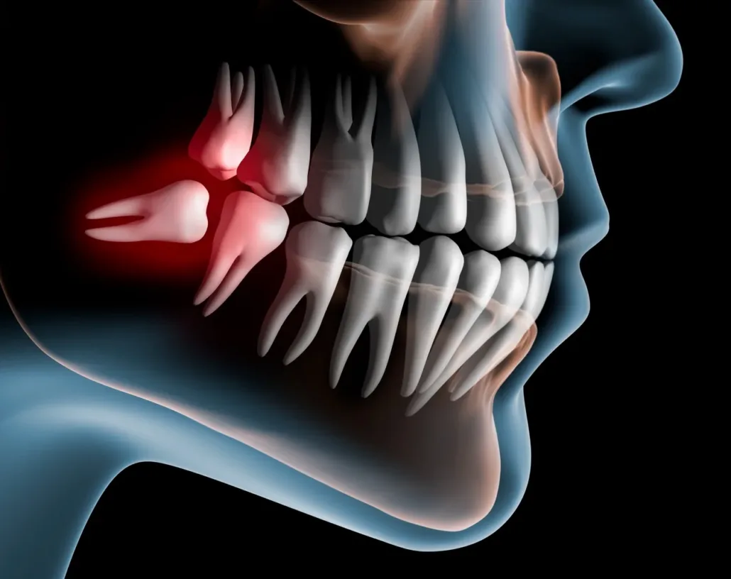 Dents De Sagesse Incluses Mont Sur Lausanne D1DentalConcept D1 Dental Concept Clinique Dentaire - Dentistes & Hygiénistes - Dents de sagesse incluses mont sur lausanne D1DentalConcept