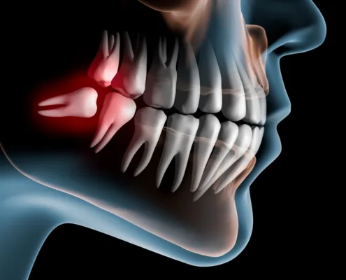 D1 Dental Concept Clinique Dentaire - Dentistes & Hygiénistes - Dents de sagesse incluses mont sur lausanne D1DentalConcept