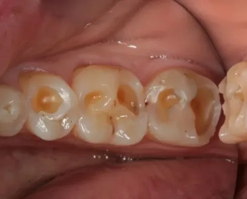 D1 Dental Concept Clinique Dentaire - Dentistes & Hygiénistes - Erosion dentaire molaires mont sur lausanne D1DentalConcept