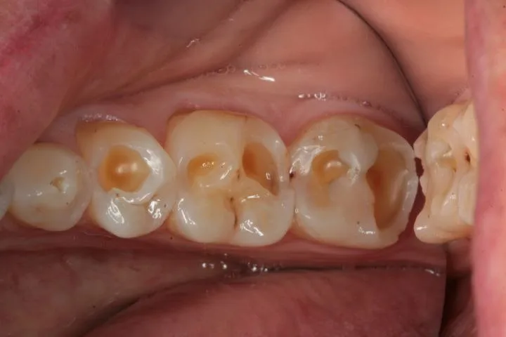 D1 Dental Concept Clinique Dentaire - Dentistes & Hygiénistes - Erosion dentaire molaires mont sur lausanne D1DentalConcept