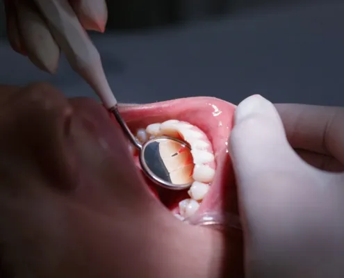 D1 Dental Concept Clinique Dentaire - Dentistes & Hygiénistes - Examen gencives parodontologie mont sur lausanne D1DentalConcept