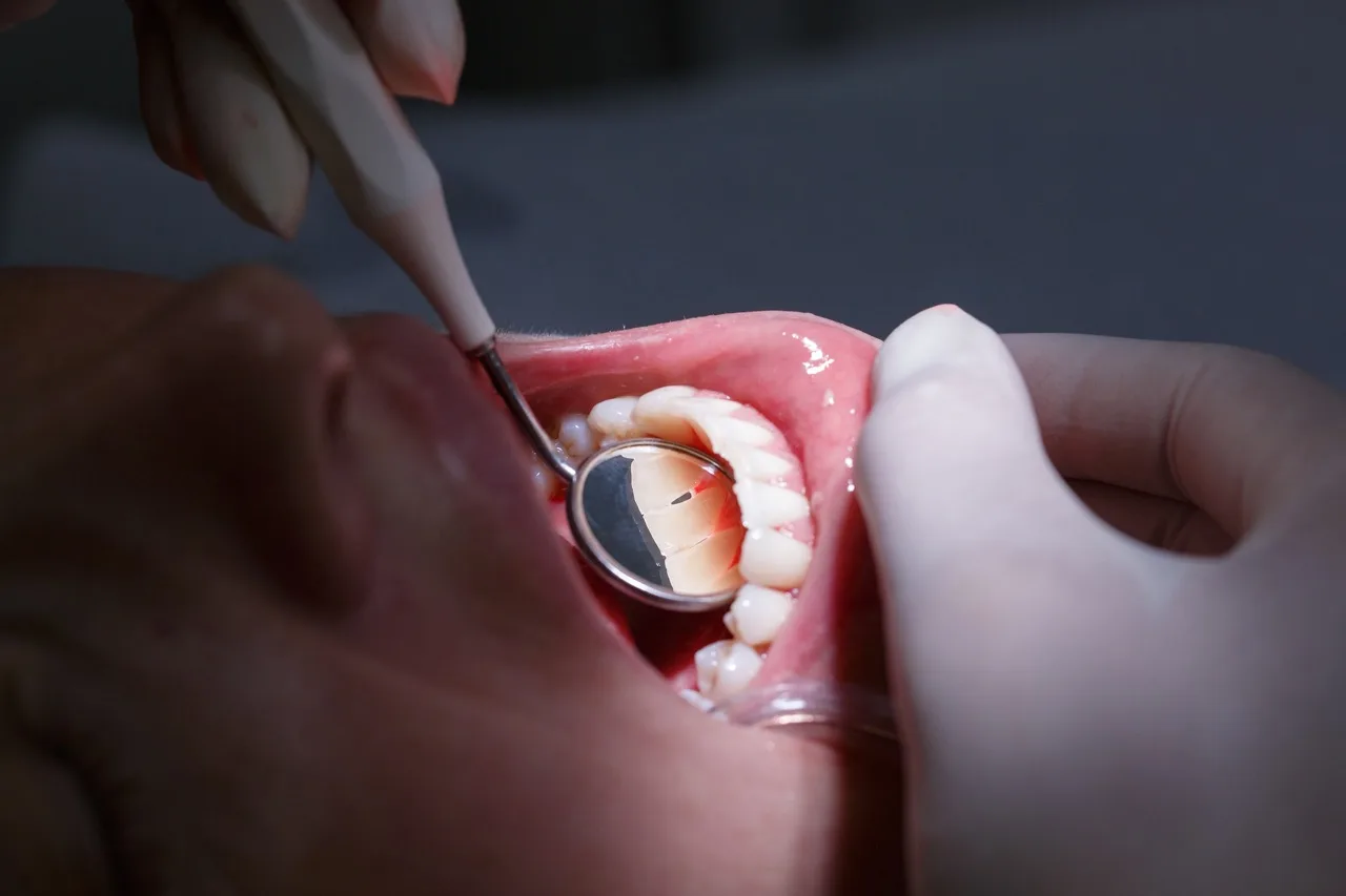 D1 Dental Concept Clinique Dentaire - Dentistes & Hygiénistes - Examen gencives parodontologie mont sur lausanne D1DentalConcept