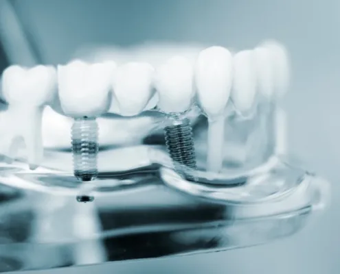 D1 Dental Concept Clinique Dentaire - Dentistes & Hygiénistes - Implants dentaires mont sur lausanne D1DentalConcept