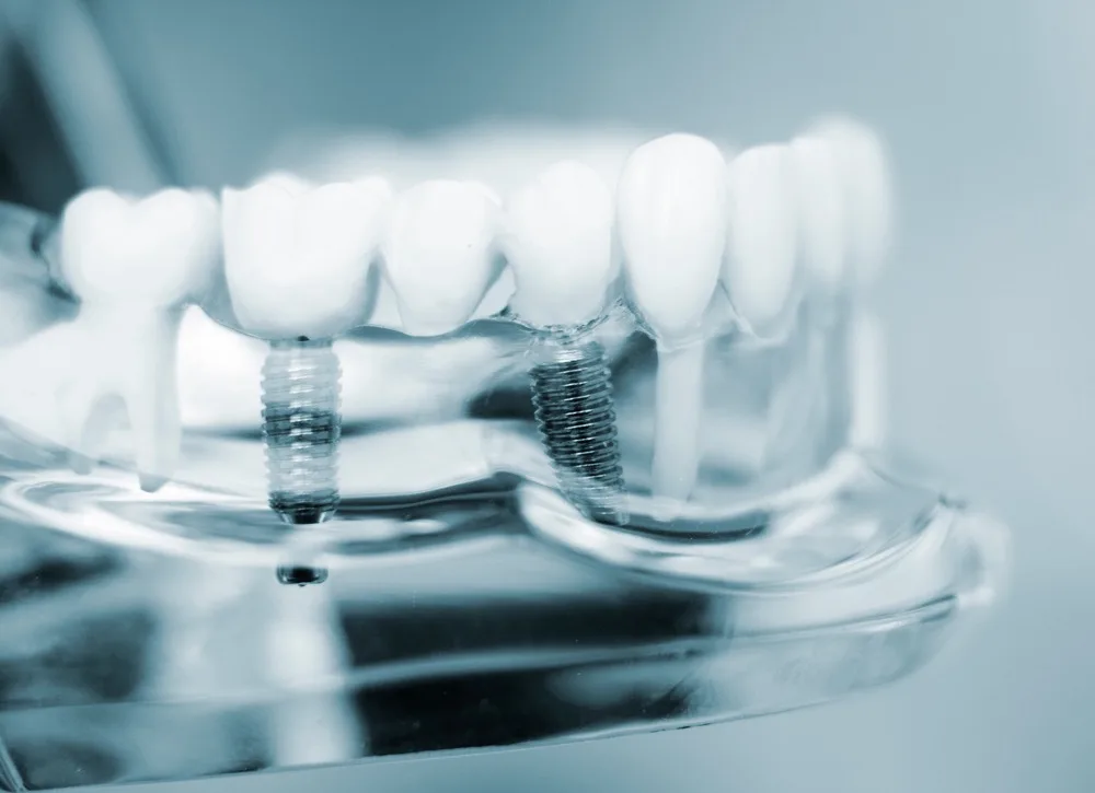 D1 Dental Concept Clinique Dentaire - Dentistes & Hygiénistes - Implants dentaires mont sur lausanne D1DentalConcept